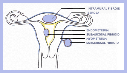 An Unusual Case of Vaginal Myoma Presenting with Postmenopausal